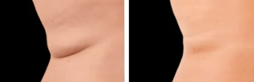 Exion-body-treatment-before-and-after (1)