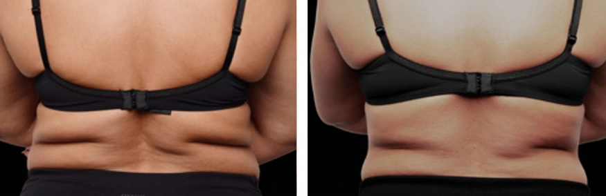 Exion-body-treatment-before-and-after (2)