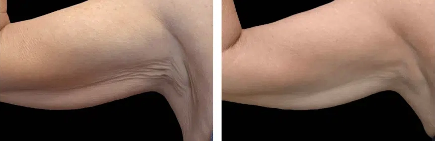 Exion-body-treatment-before-and-after (3)